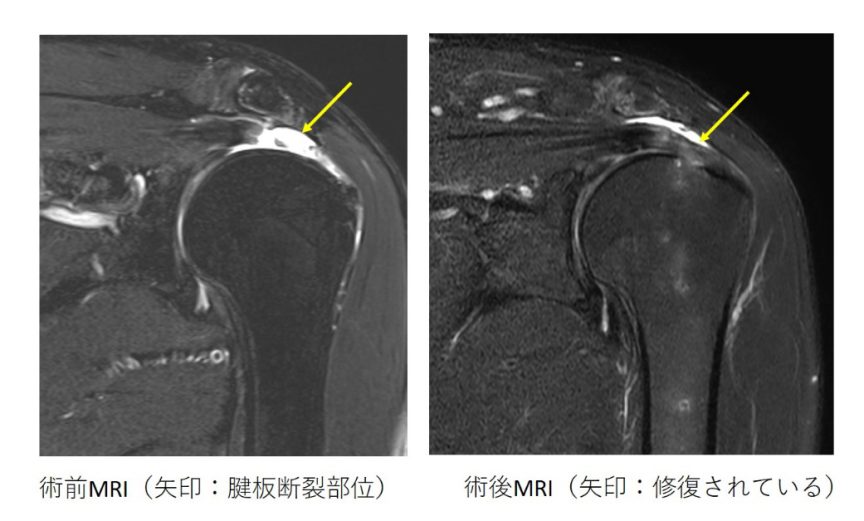 上肢（肩・肘・手） - 島根大学医学部整形外科学教室